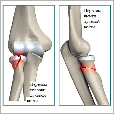   Elbow  ortoped-klinikcom